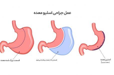 عمل اسلیو معده چیست