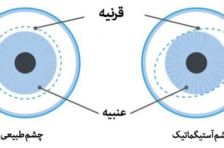 آستیگماتیک چشم چیست و درمان آن