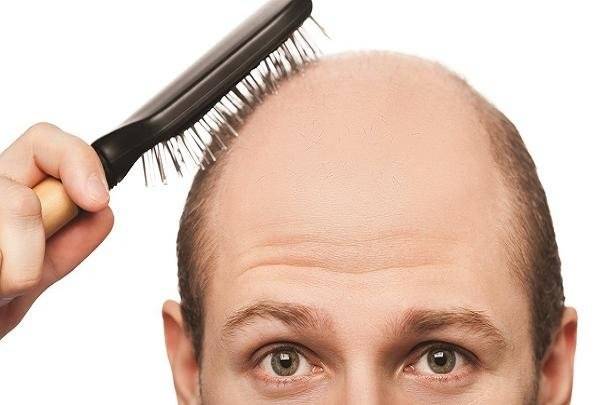 ارتباط نوشیدنی های شیرین با ریزش مو در مردان