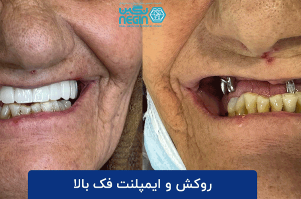 کاشت ایمپلنت دندان در کلینیک دندانپزشکی نگین شیراز