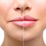 ۶ تفاوت فیلر لب با ژل لب که باید بدانید