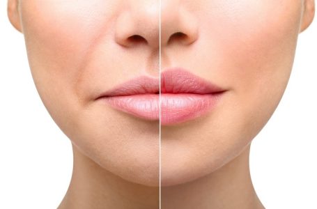 ۶ تفاوت فیلر لب با ژل لب که باید بدانید