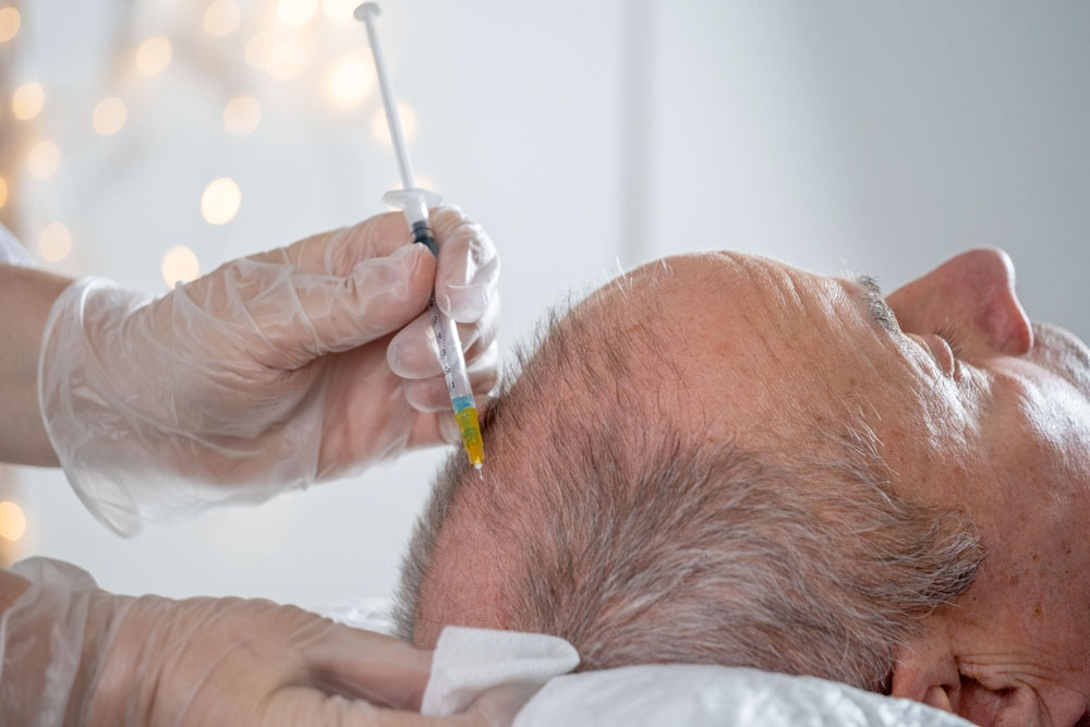 اگزوزوم تراپی مو در مرکز زیبایی دکتر کیانپیشه