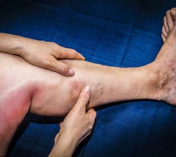 آمبولی بعد از عمل جراحی زانو