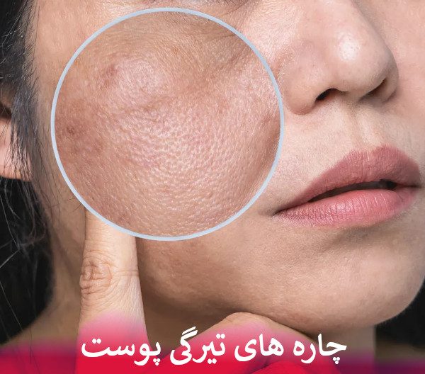 چاره های تیرگی پوست