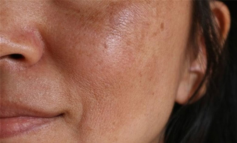 چاره های تیرگی پوست