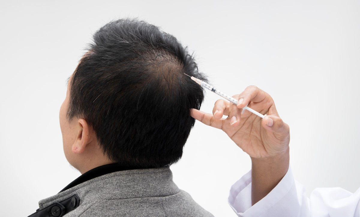 اگزوزوم تراپی مو؛ جدیدترین روش بازسازی و تقویت ریشه مو با نتایج ماندگار