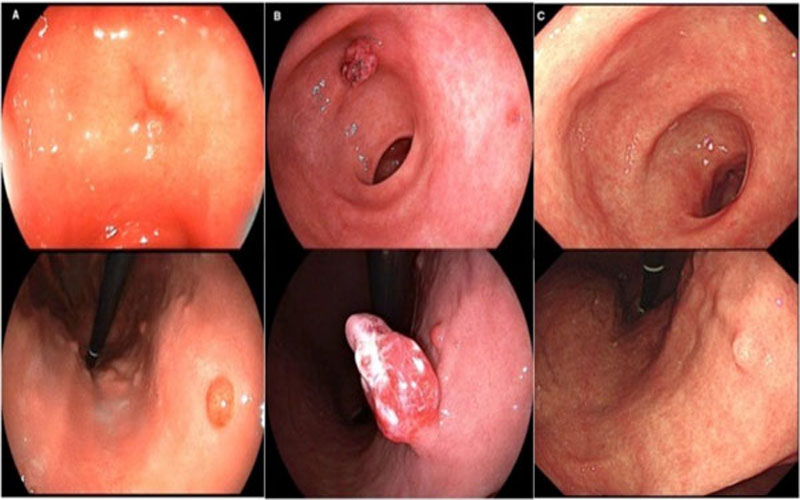 اورژانسی‌ترین موارد برای انجام آندوسکوپی