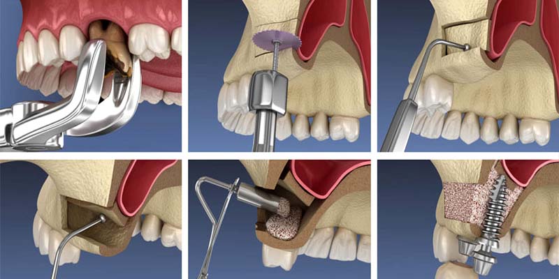 هزینه سینوس لیفت و ایمپلنت چقدر است؟
