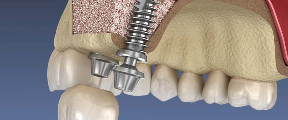 سینوس لیفت برای ایمپلنت