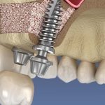 سینوس لیفت برای ایمپلنت