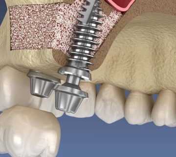 سینوس لیفت برای ایمپلنت