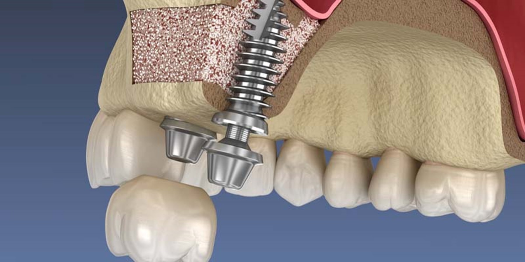 سینوس لیفت برای ایمپلنت