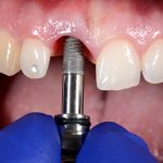 تفاوت ایمپلنت دیجیتال و معمولی