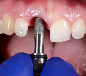 تفاوت ایمپلنت دیجیتال و معمولی