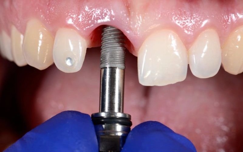تفاوت ایمپلنت دیجیتال و معمولی