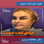 شفاف سازی هزینه های عمل لیفت صورت