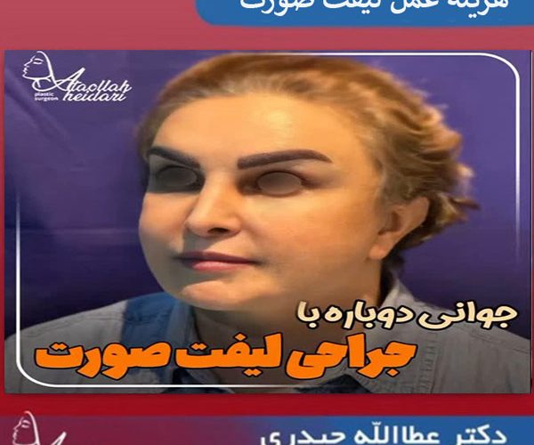 شفاف سازی هزینه های عمل لیفت صورت