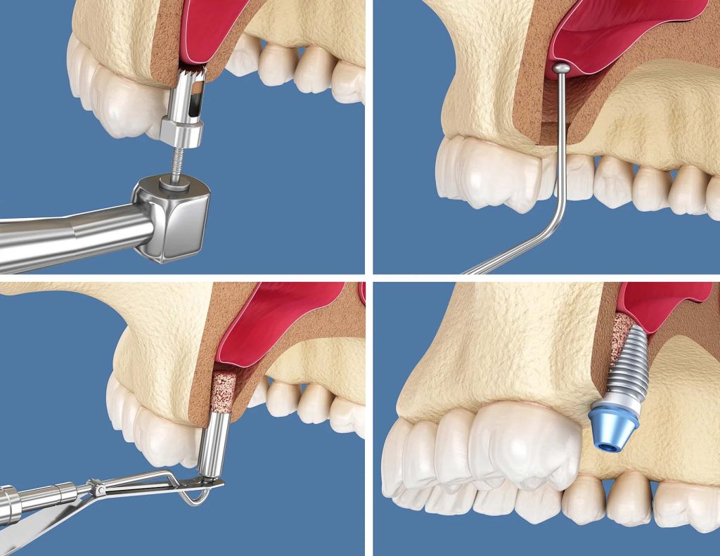 انواع جراحی سینوس لیفت: باز (Lateral) یا بسته (Osteotome)، کدامیک برای شما مناسب است؟