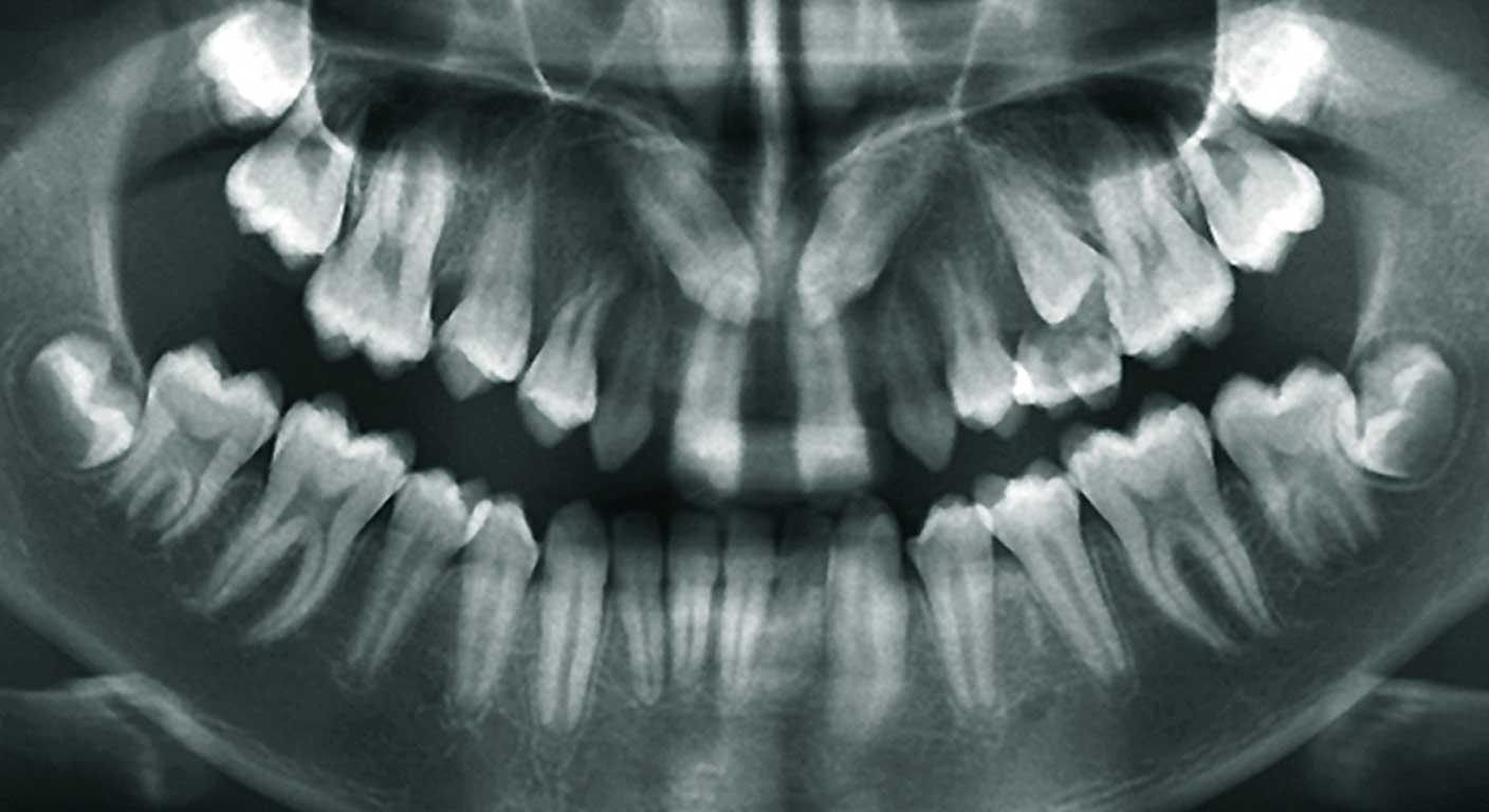عکس سه بعدی دندان برای ارتودنسی یا CBCT