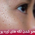 راز محو شدن لکه های تیره پوست