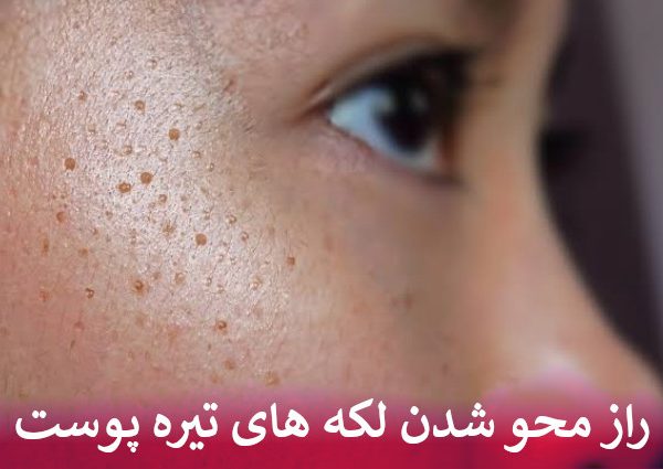 راز محو شدن لکه های تیره پوست