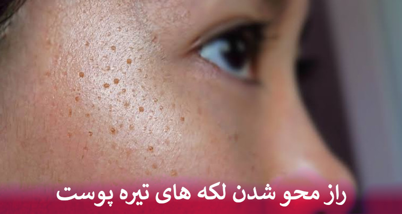 راز محو شدن لکه های تیره پوست