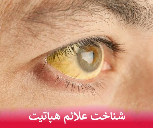شناخت علائم هپاتیت