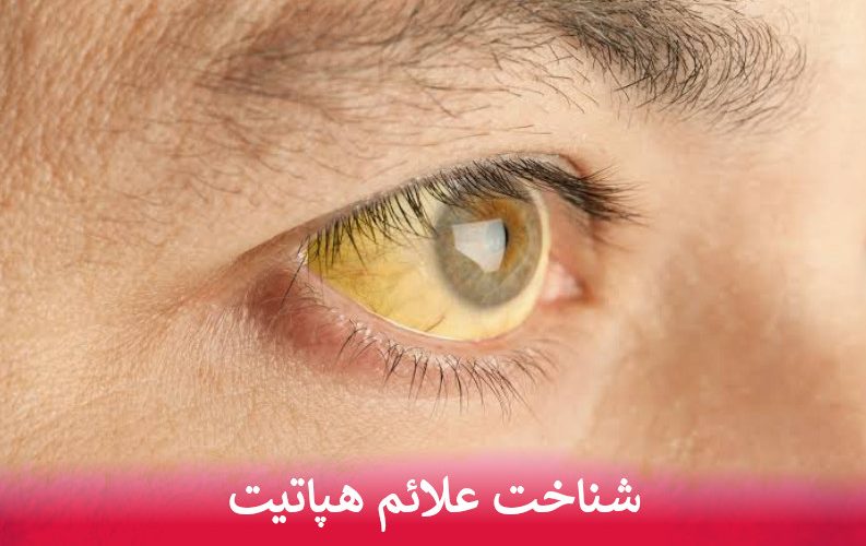شناخت علائم هپاتیت