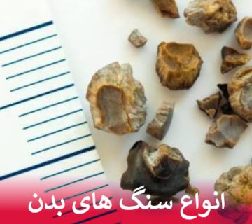 انواع سنگ های بدن