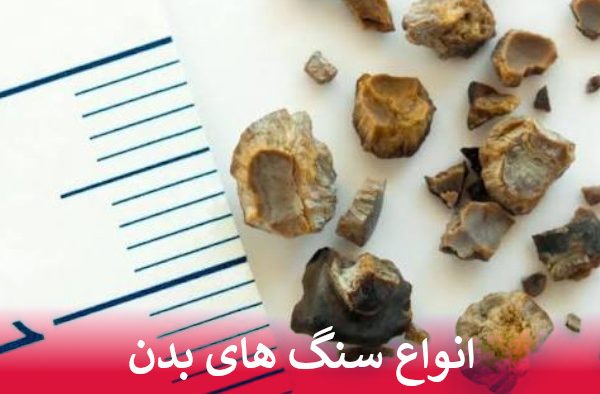انواع سنگ های بدن