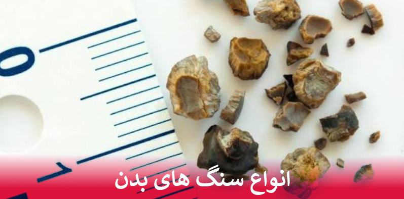 انواع سنگ های بدن