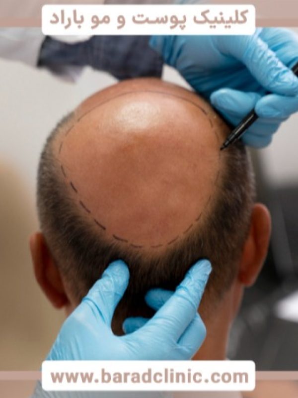 راز ماندگاری کاشت مو چیست؟ جدیدترین تکنیک_های کاشت مو زیر ذره_بین متخصصان