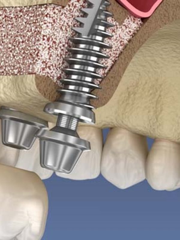 سینوس لیفت برای ایمپلنت