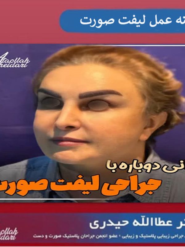 شفاف سازی هزینه های عمل لیفت صورت